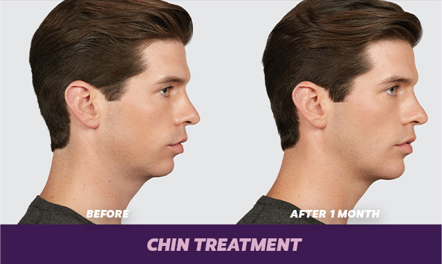 voluma filler