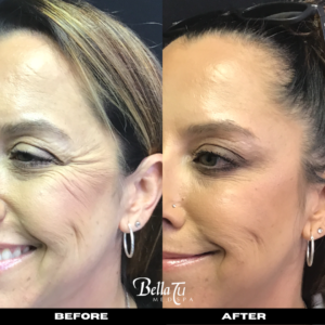 Botox Gallery #1