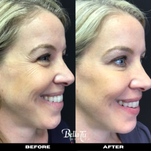 Botox Gallery #2