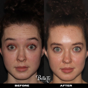 Botox Gallery #4